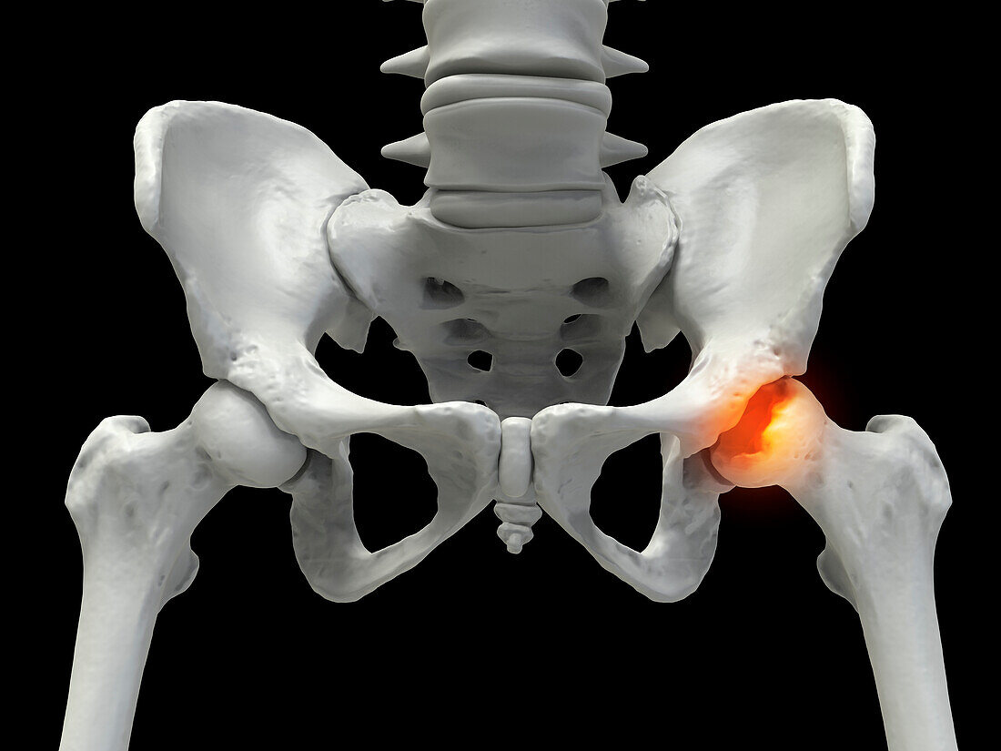 Legg-Calve-Perthes disease, illustration