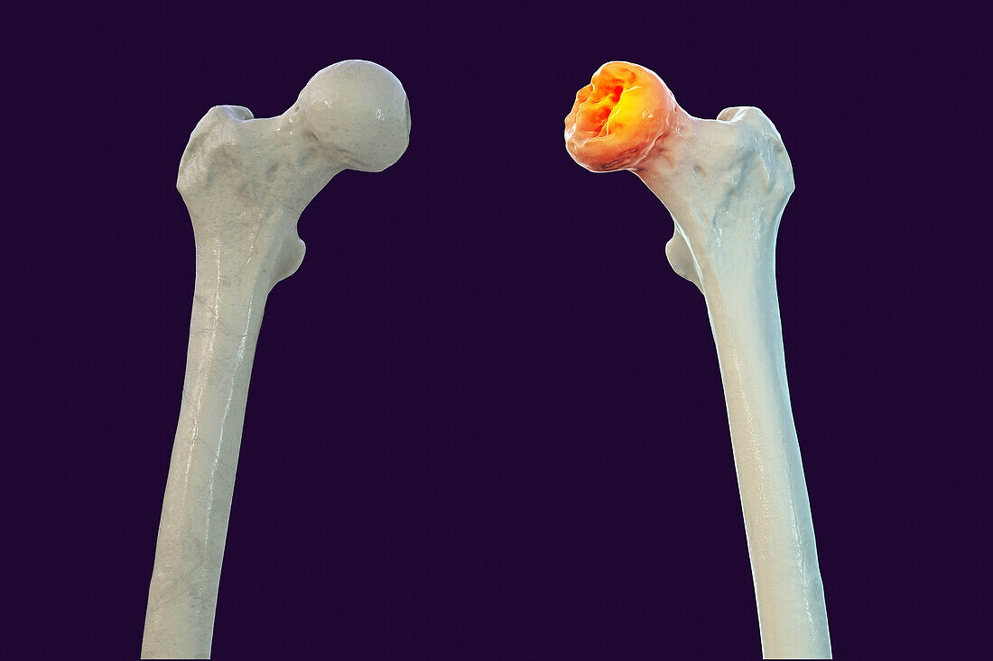 Legg-Calve-Perthes disease, illustration