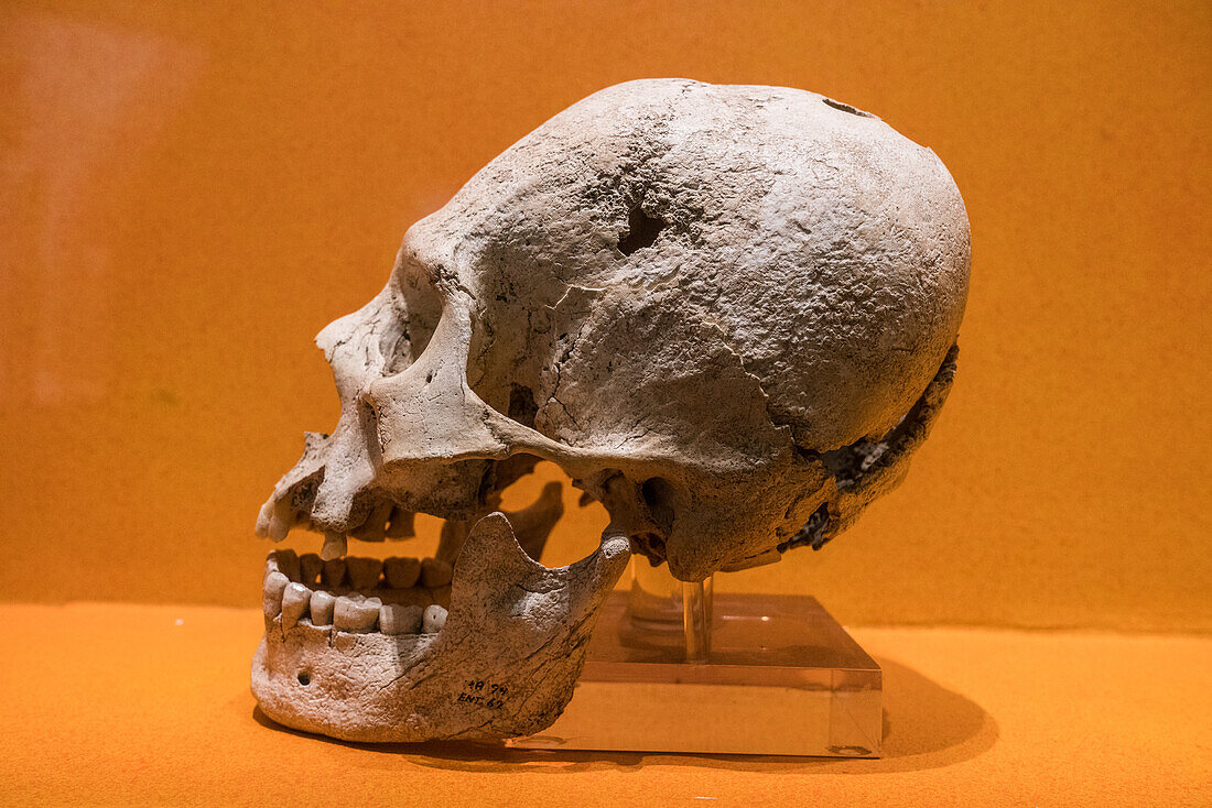 A skull from the ruins of Monte Alban showing cranial deformation and trepanation surgery. Monte Alban Site Museum, Oaxaca, Mexico. A UNESCO World Heritage Site.