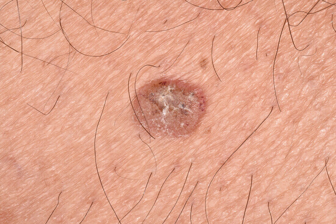 Seborrheic keratosis