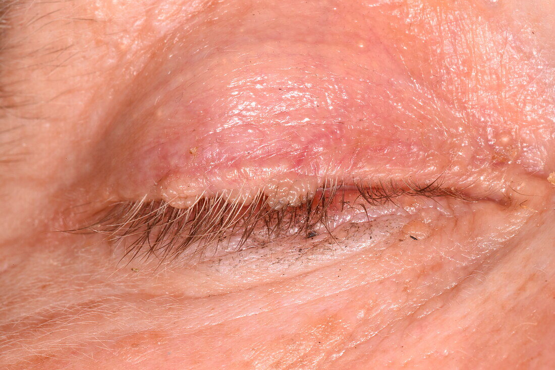 Multiple eyelid papillomas