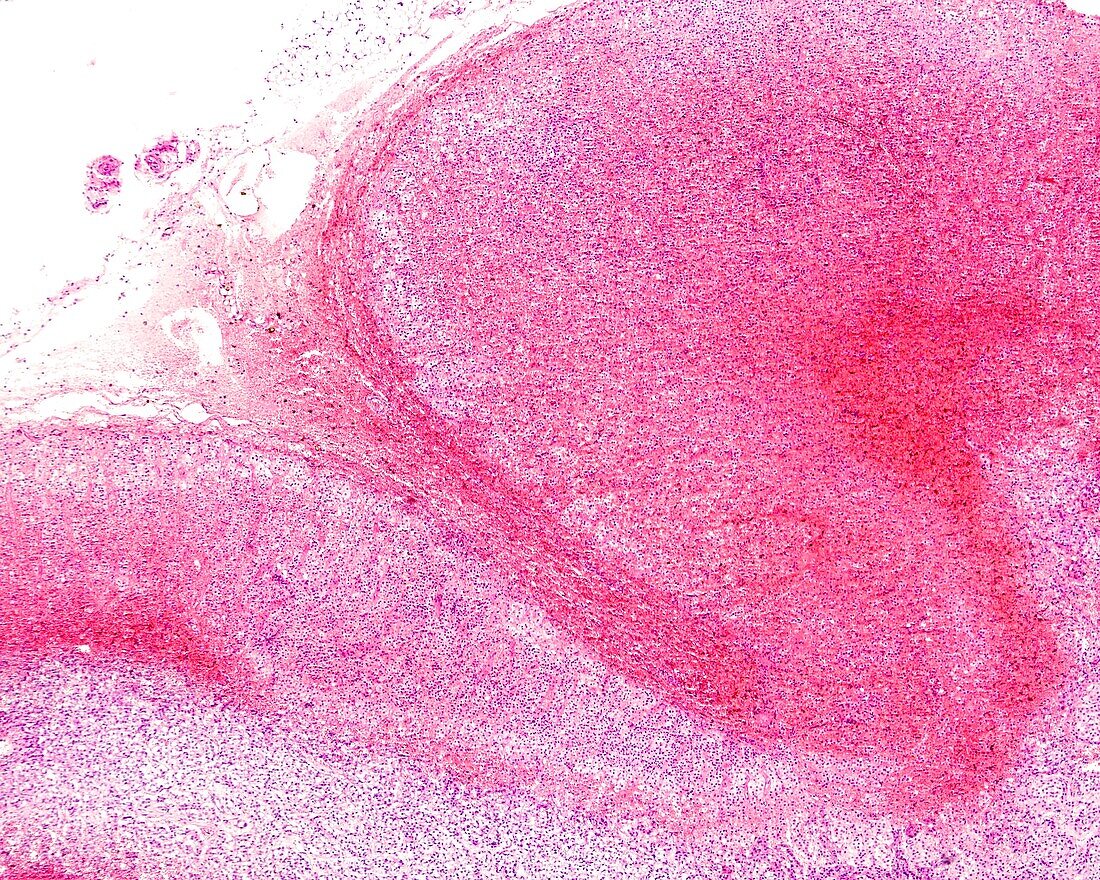 Waterhouse-Friderichsen syndrome, light micrograph