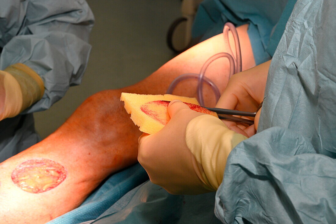 Surgeon cutting surgical sponge during a skin graft
