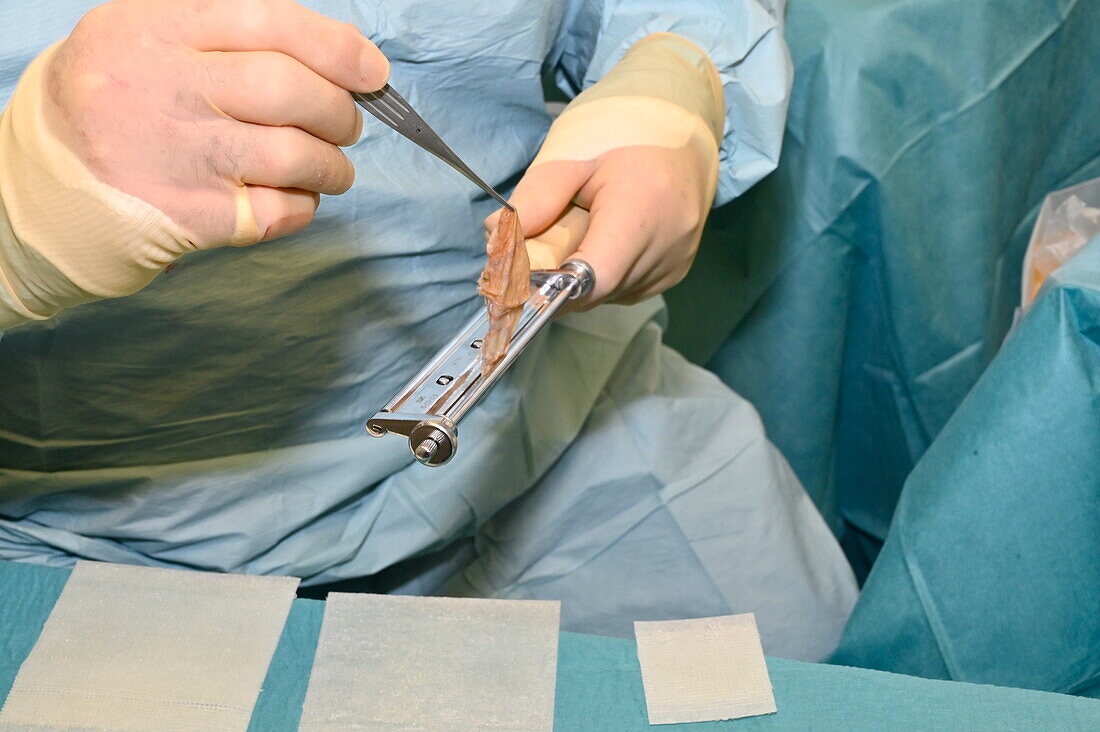 Surgeon holding skin graft taken from a patient's thigh