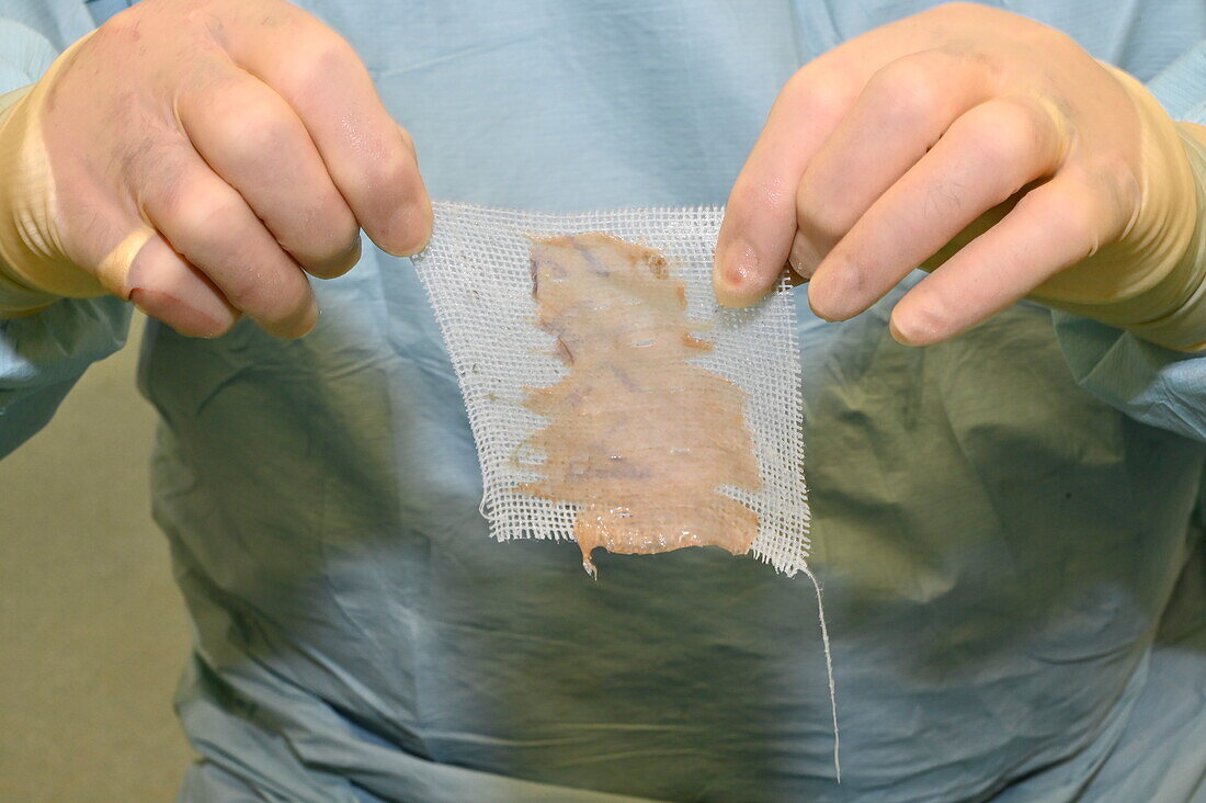 Surgeon holding a skin graft on a gauze