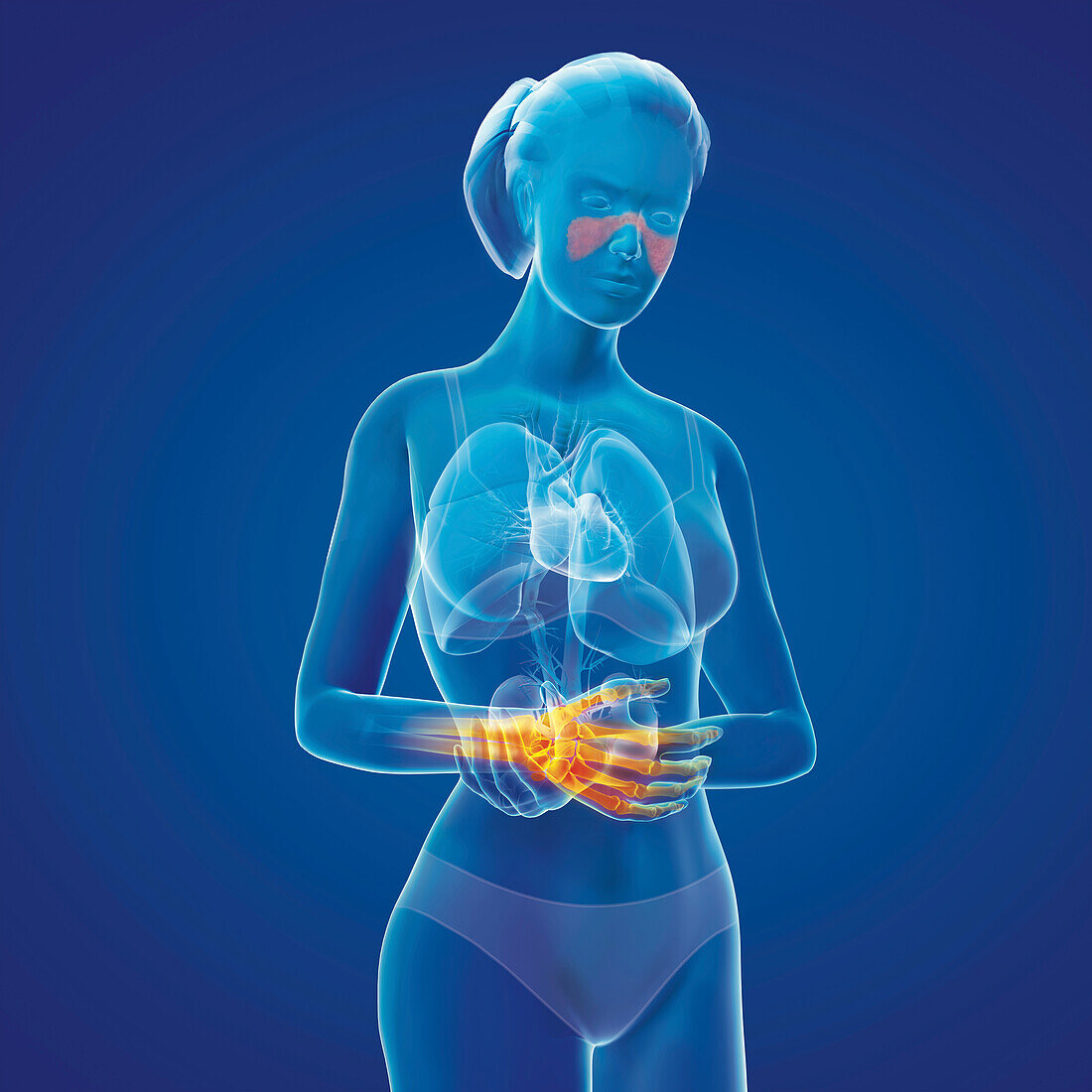 Organs affected by lupus autoimmune disease, illustration