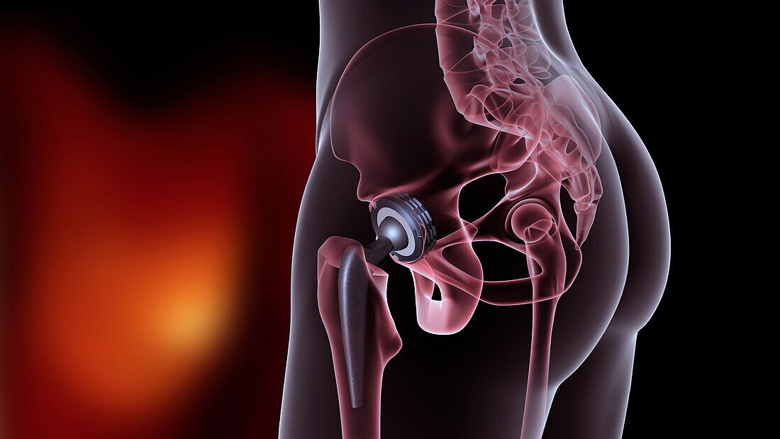 Prosthetic hip joint, illustration