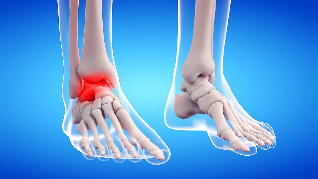 Painful ankle joint, illustration