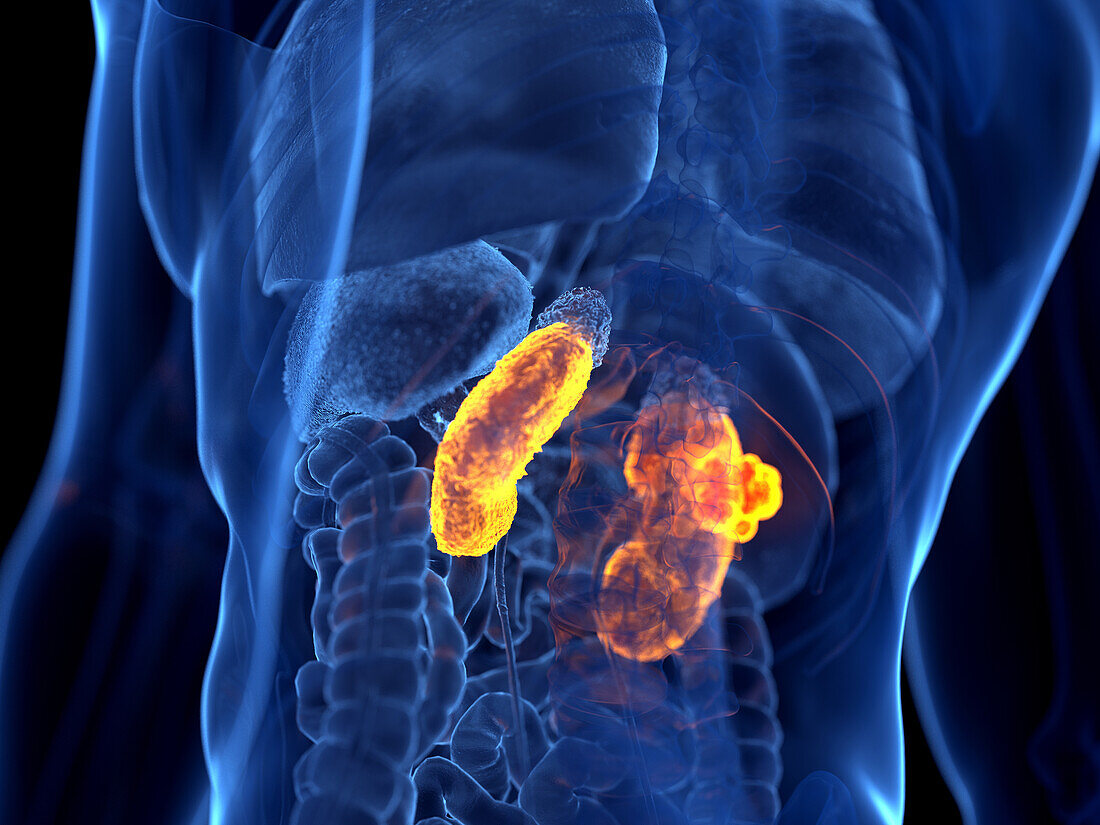 Kidney cancer, illustration