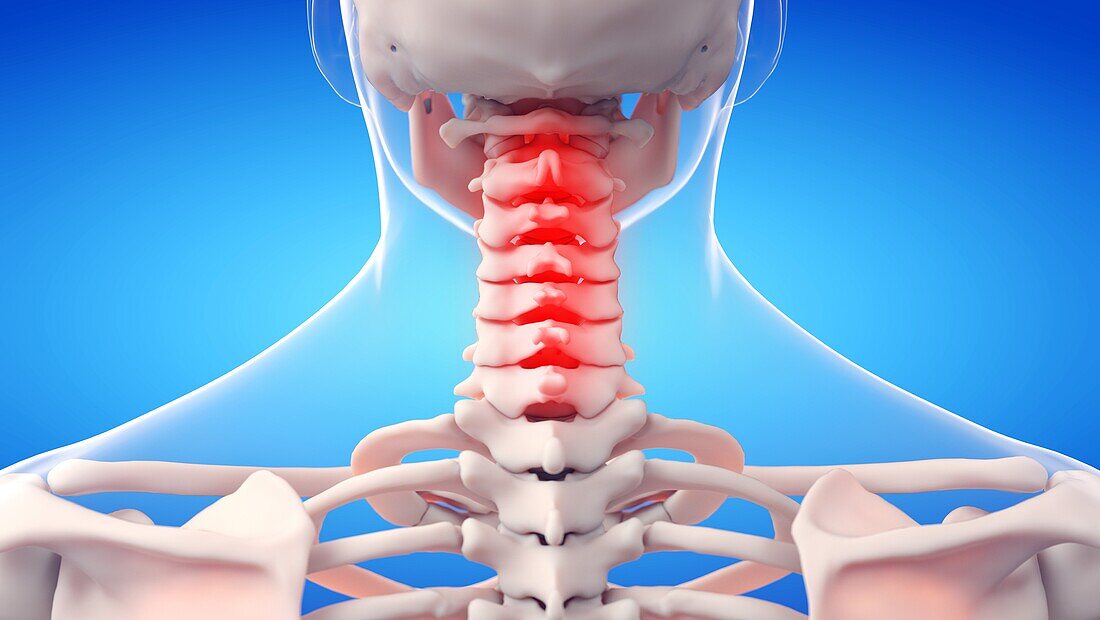 Painful cervical spine, illustration