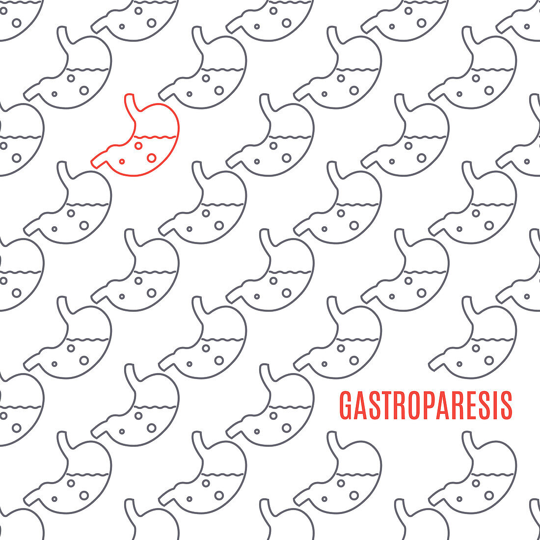 Gastroparesis, conceptual illustration