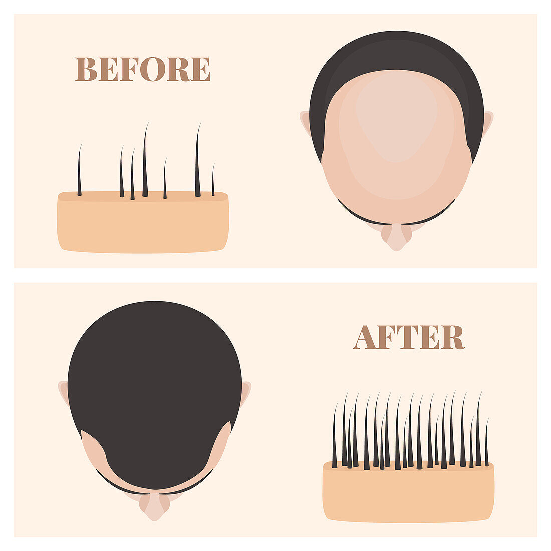 Alopecia treatment, illustration
