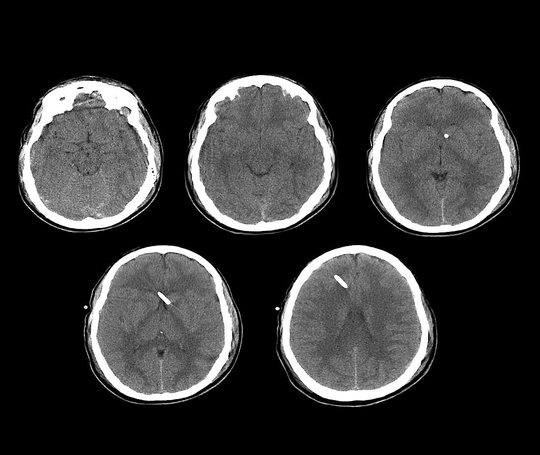 Cerebral oedema, CT scan