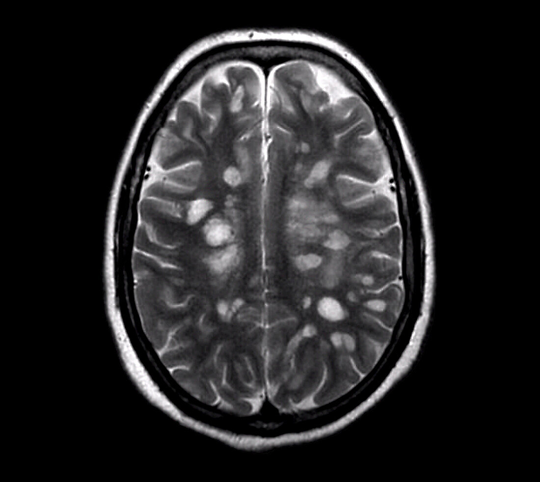 Multiple sclerosis, MRI scan