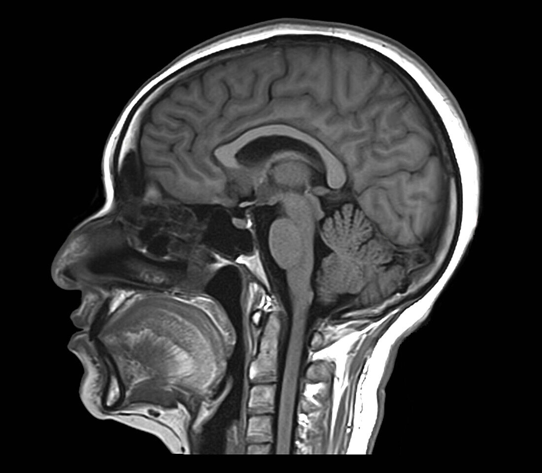Healthy pineal gland, MRI scan