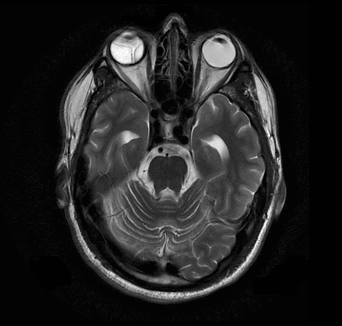 Retinal detachment, MRI scan