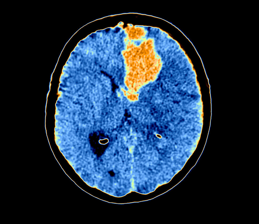 Brain haemorrhage, CT scan