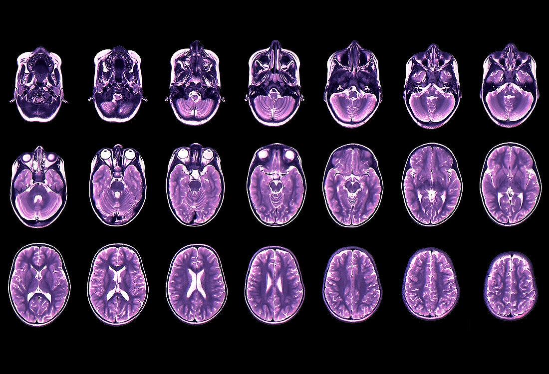 Normal brain of a child, MRI scans