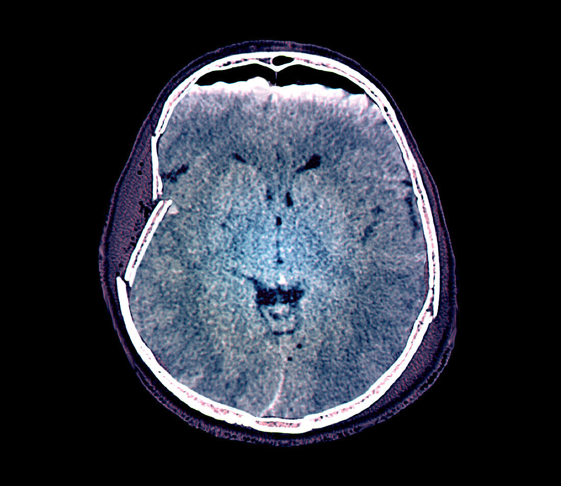 Traumatic brain injury, CT scan