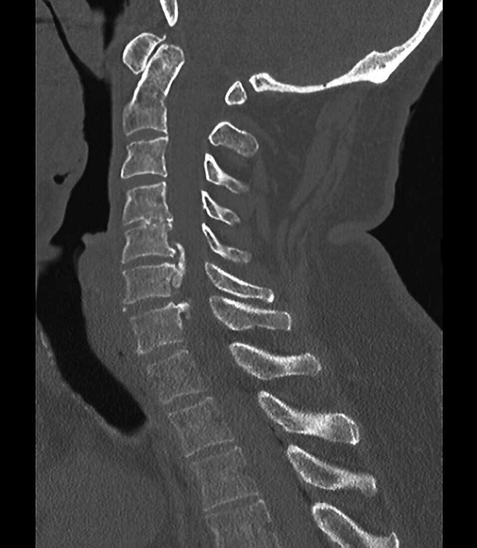 Osteoarthritis of the cervical spine, CT scan