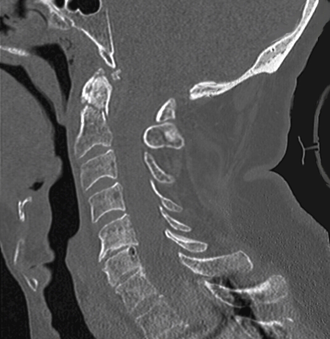 Fractured cervical vertebra, CT scan