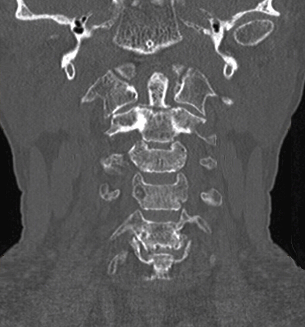 Fractured cervical vertebra, CT scan