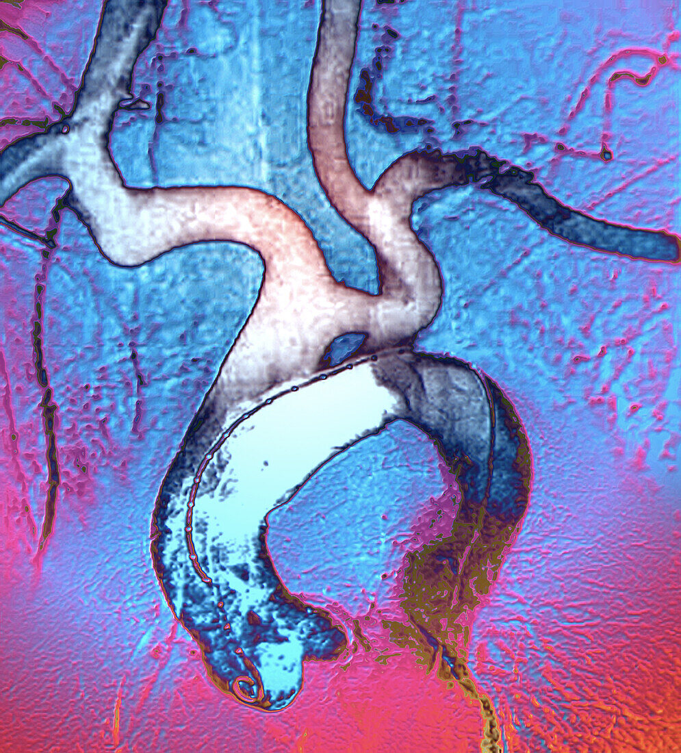 Aortic aneurysm, angiogram
