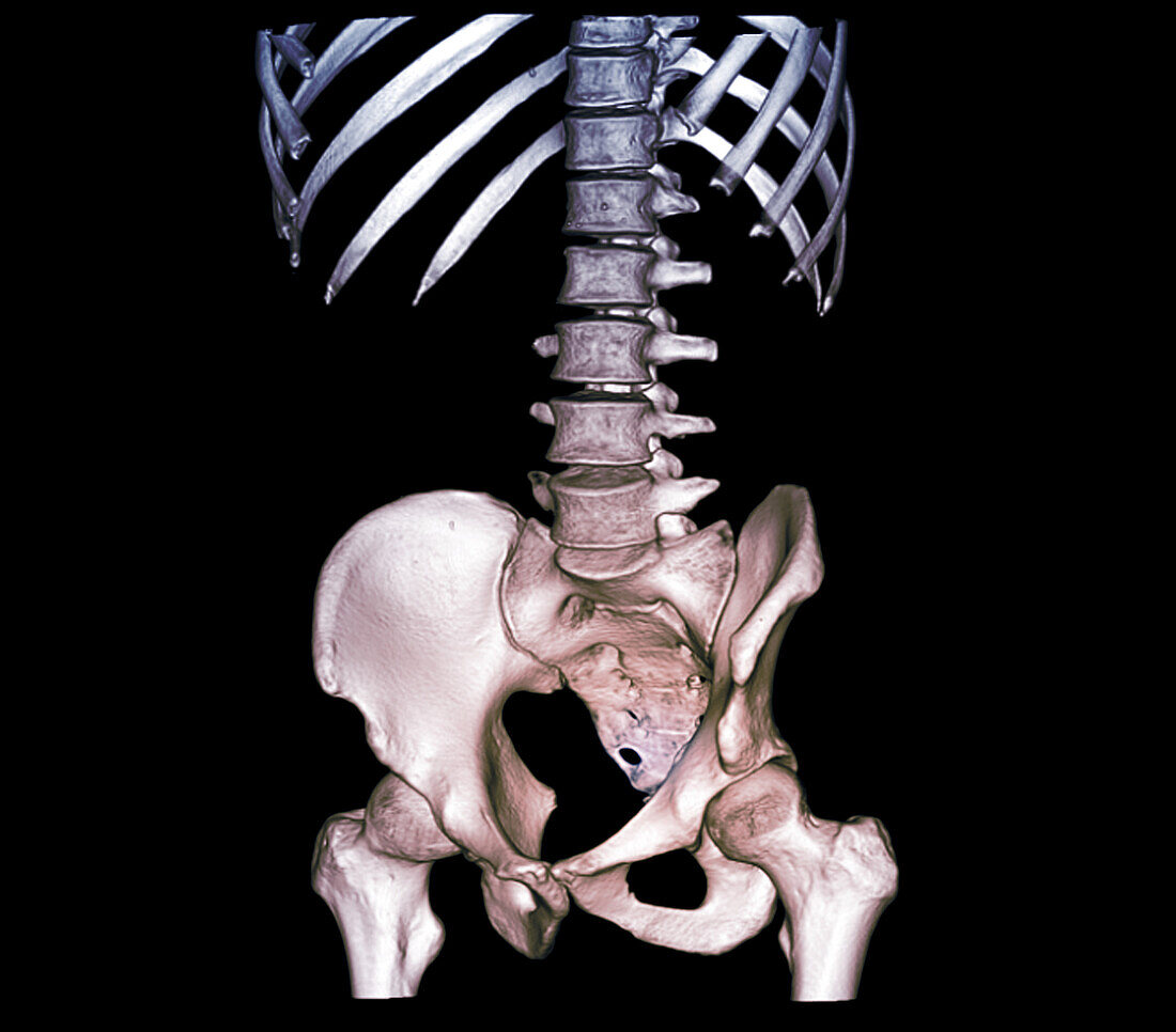 Healthy lower spine, CT scan