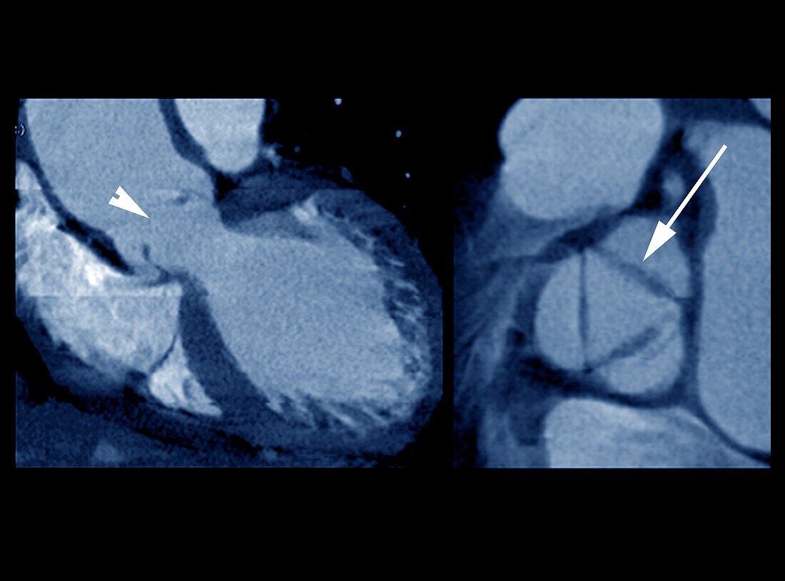 Aortic valve insufficiency, CT scans