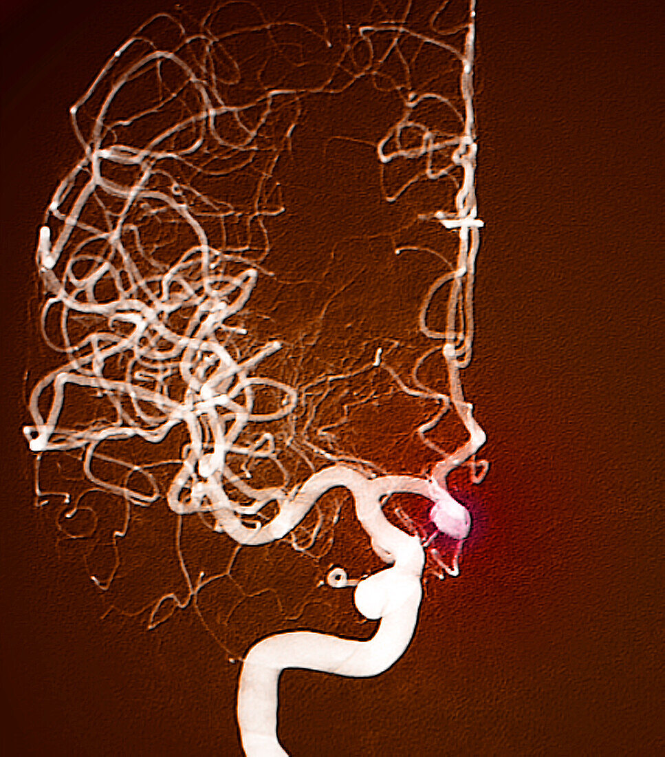 Brain aneurysm, angiogram