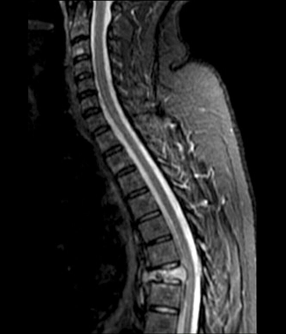 Spinal cancer, MRI scan