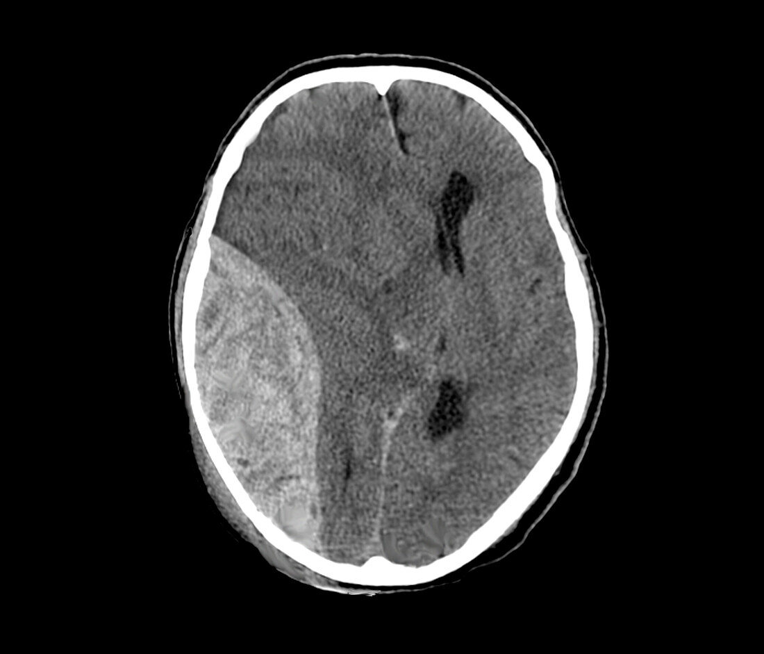 Extradural haematoma, CT scan