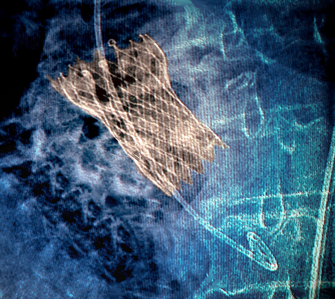 Prosthetic aortic valve, X-ray