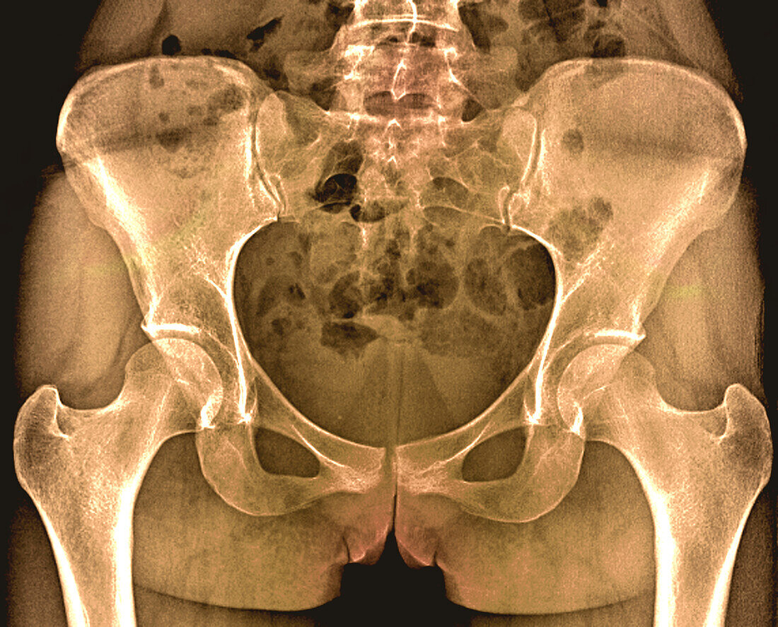 Healthy pelvis and hips, X-ray