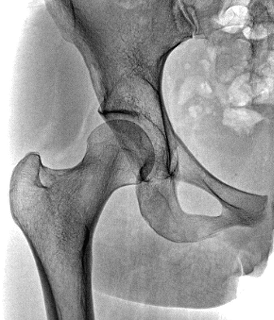 Healthy hip, X-ray