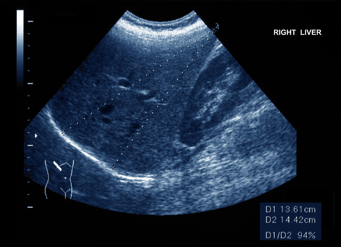Normal liver, ultrasound scan
