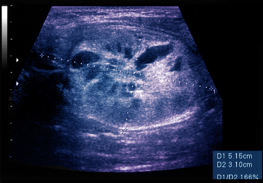 Thyroid nodule, ultrasound scan