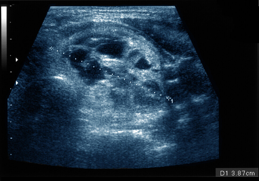 Thyroid nodule, ultrasound scan