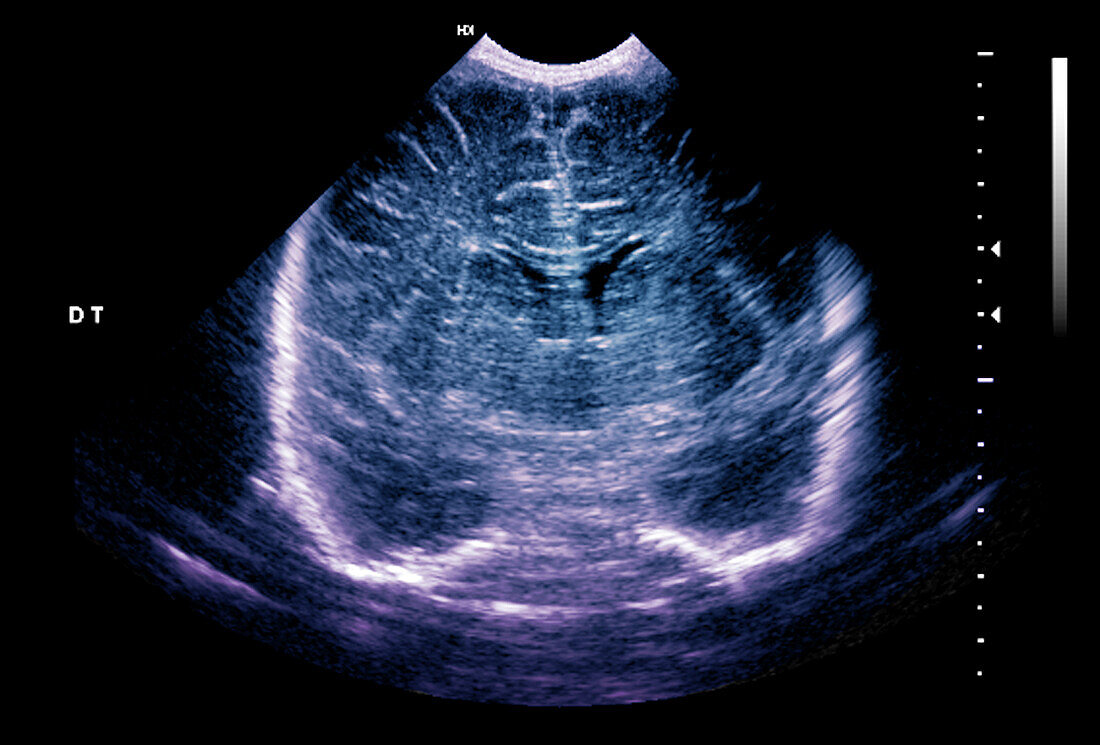 Normal premature newborn baby brain development, ultrasound