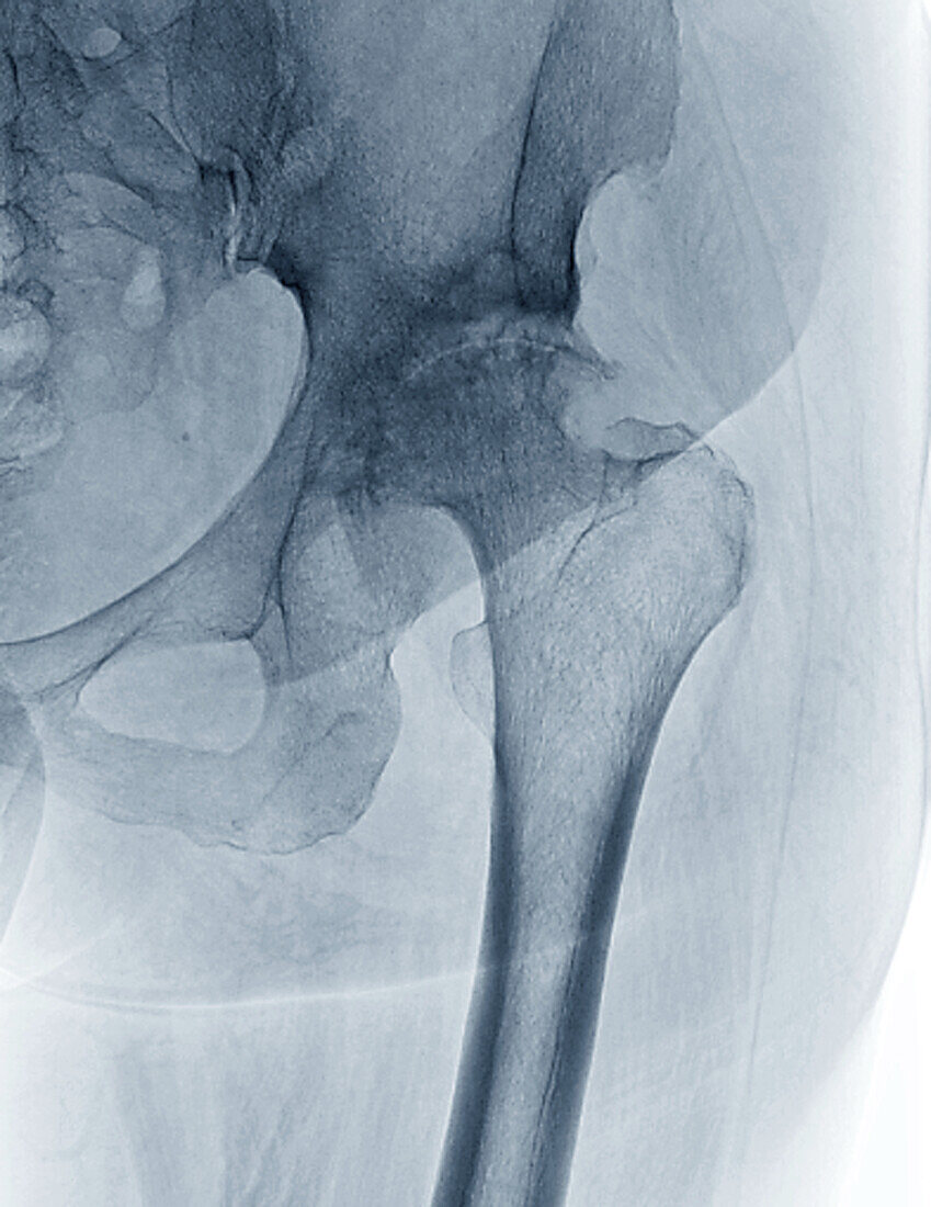 Osteoarthritis of the hip, X-ray