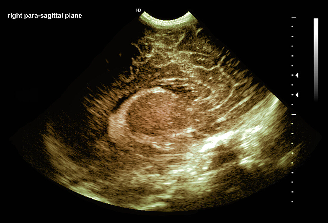 Premature baby normal brain development, ultrasound scan