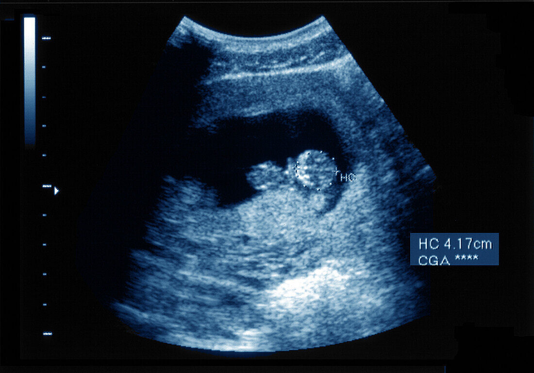 Intrauterine pregnancy, ultrasound scan