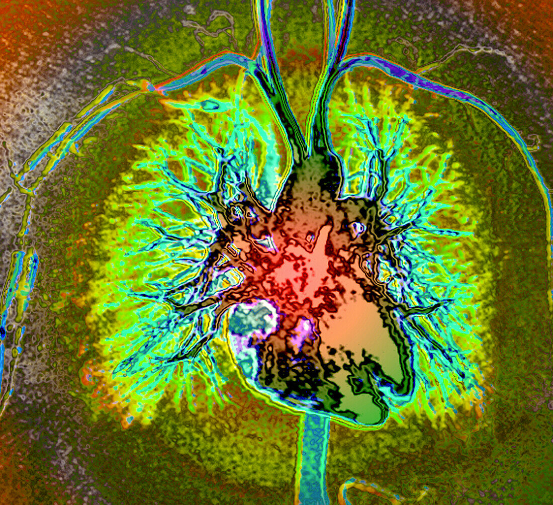 Heart and blood vessels, MRI angiogram