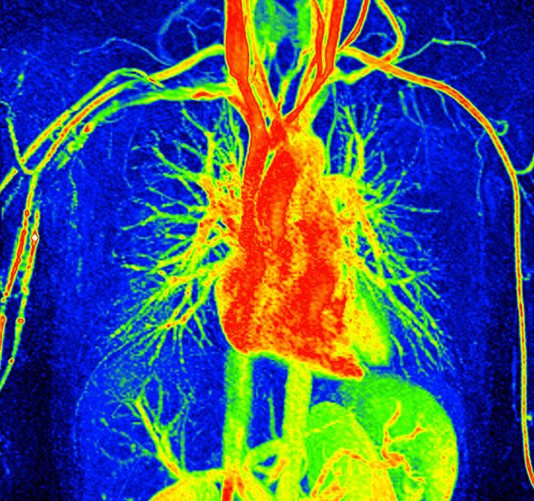 Healthy heart and blood vessels, MRI angiogram
