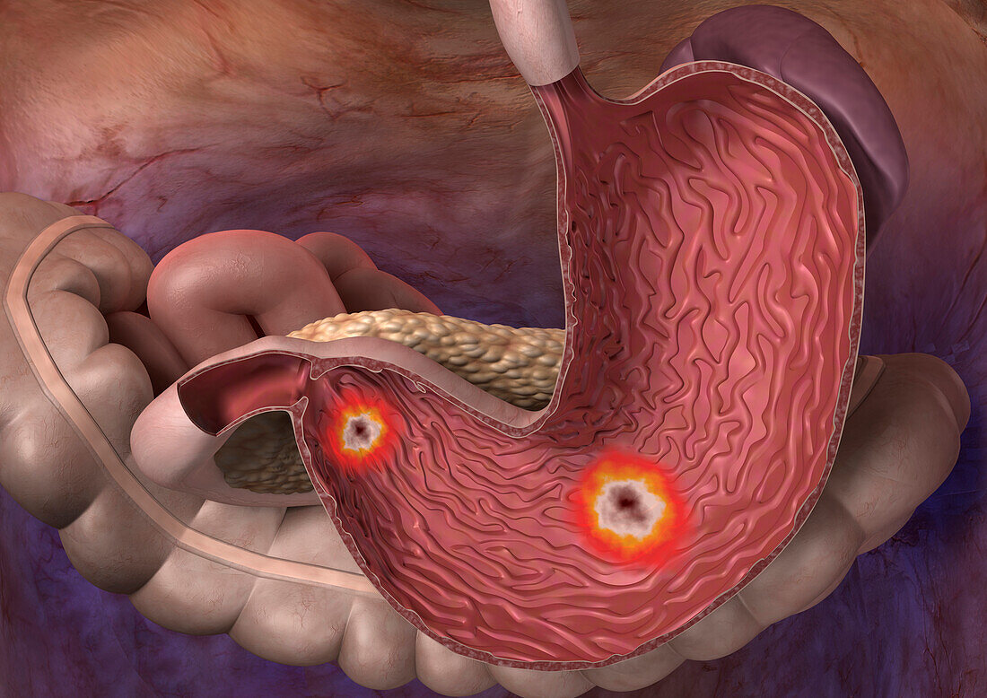 Gastric ulcers, illustration