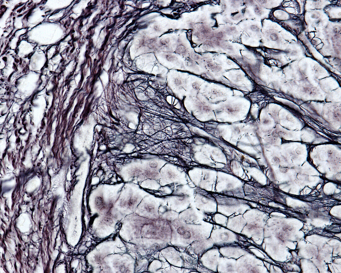 Cirrhosis, light micrograph