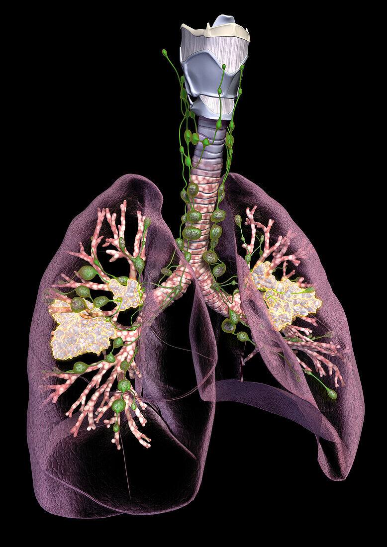 Lung cancer, illustration