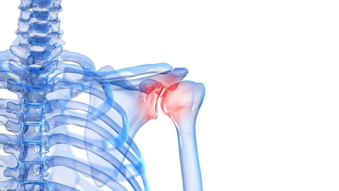 Painful shoulder, illustration