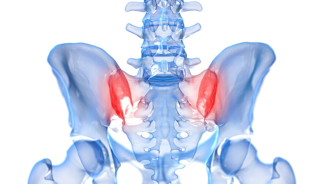 Painful sacroiliac joint, illustration