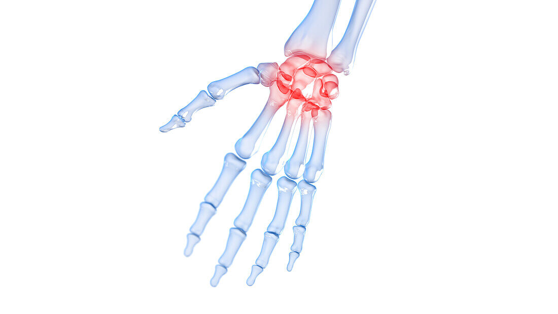 Painful hand bones, illustration